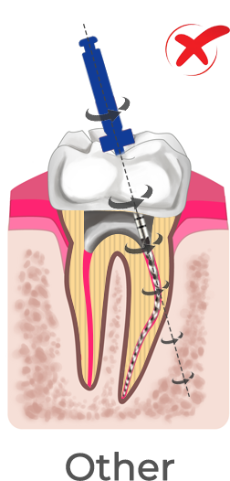 sc-plus Comply with the inherent anatomy of the root canal